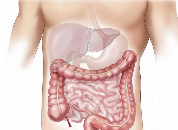 cancer de colon
