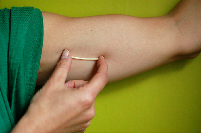 El implante anticonceptivo hormonal ¿engorda ?