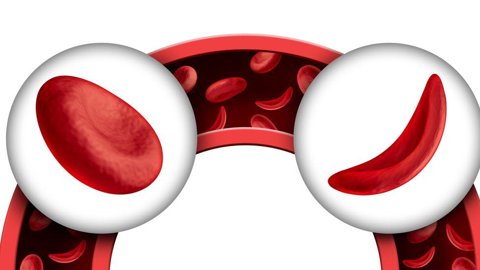 Anemia drepanocítica