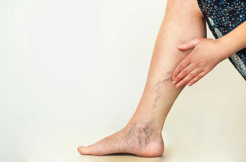 1 varices