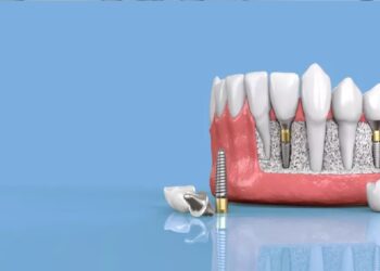 cuidar implantes dentales