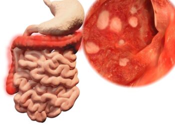 Como saber si padezco de colitis ulcerosa