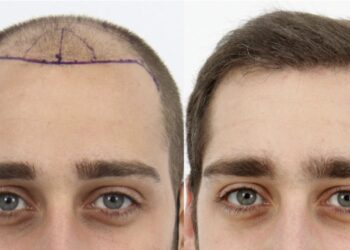 Chico con alopecia antes y despues