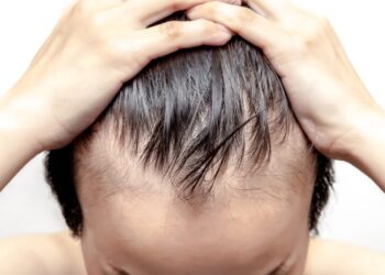 Entendiendo la alopecia: Causas, tipos y tratamientos