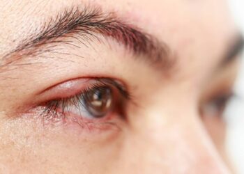 ¿Enrojecimiento, hinchazón y costras en el ojo? Sufres de blefaritis